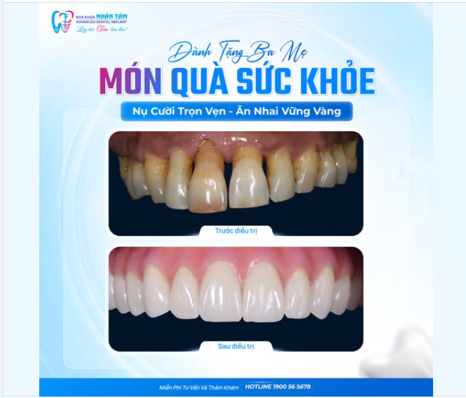 DÀNH TẶNG BA MẸ MÓN QUÀ SỨC KHỎE  NỤ CƯỜI TRỌN VẸN, ĂN NHAI VỮNG VÀNG!