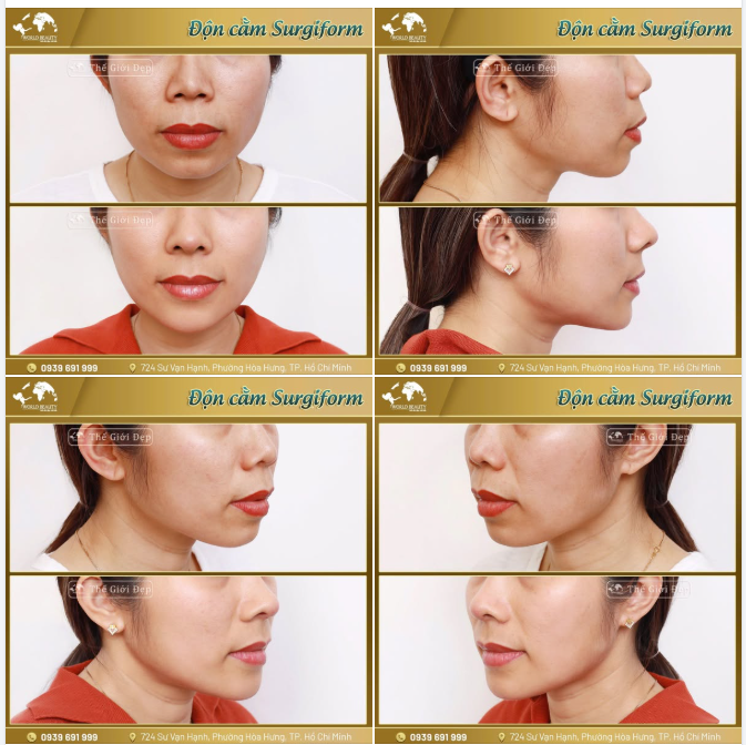 Thực tế, nhiều người thường chỉ chú ý đến mũi hoặc mắt, mà quên rằng cằm cũng là “điểm vàng” quyết định sự cân đối và thần thái gương mặt.