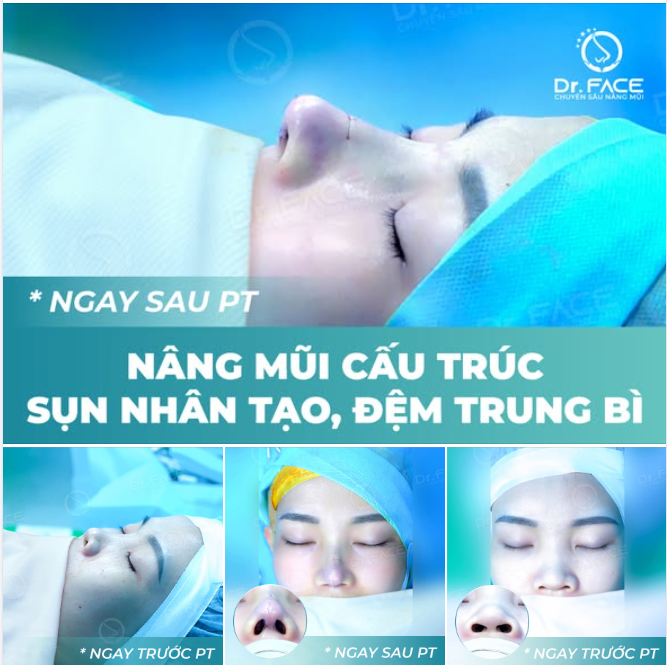 “XĂM CHÂN MÀY còn đau hơn NÂNG MŨI”