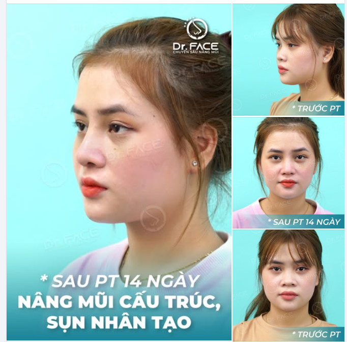 MŨI TỰ NHIÊN NÈ, MÀ AI NÓI HÔNG ĐẸP?