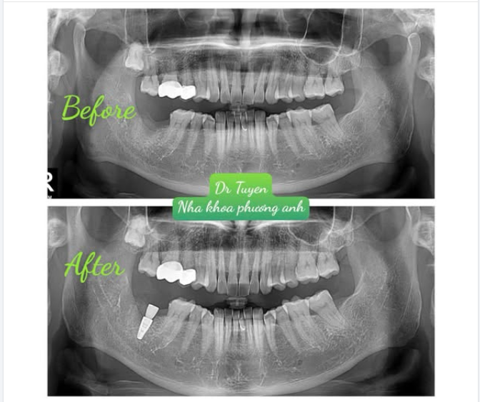 So Sánh Hàm Giả Tháo Lắp Và Trồng Răng Implant