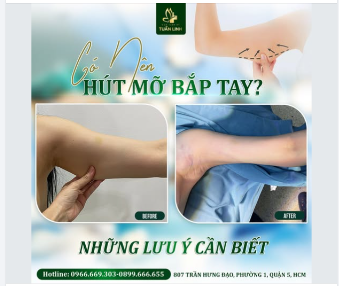 Hút mỡ bắp tay – Những điều cần biết!