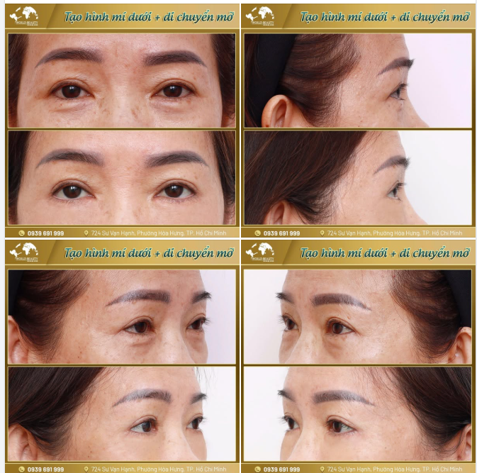Ở độ tuổi trung niên, những dấu hiệu lão hóa sẽ dần xuất hiện và ngày càng rõ hơn thông qua đôi mắt như: bọng m.ỡ mí dưới, rãnh nhăn, nếp nhăn, da tối màu khiến gương mặt kém tươi tắn.
