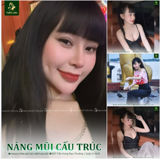 Nâng mũi cấu trúc - Dáng mũi thiết kế - Đẹp chuẩn tỉ lệ!!