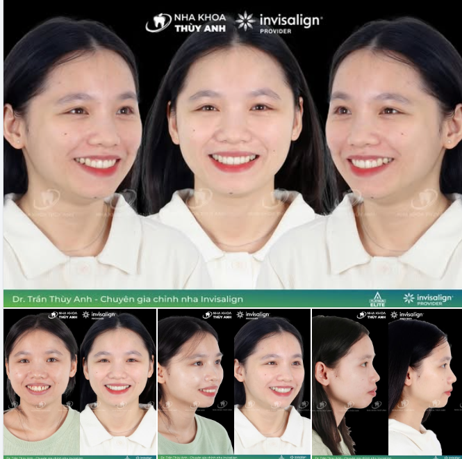 HÔ HÀM, LÙI CẰM – KHÔNG NHỔ RĂNG VẪN ĐẠT KẾT QUẢ VƯỢT MONG ĐỢI VỚI KHAY NIỀNG INVISALIGN