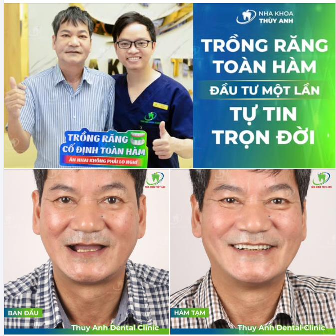 KHÔNG CÒN CẢNH ĂN NHAI KHÓ KHĂN VỚI HÀM THÁO LẮP, HỒI SINH NỤ CƯỜI VỚI IMPLANT TOÀN HÀM