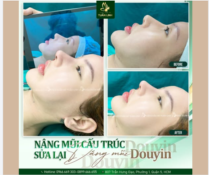 Nâng mũi siêu cấu trúc sửa lại - Chóp mũi Douyin hottrend, đẹp, sang, cá tính.