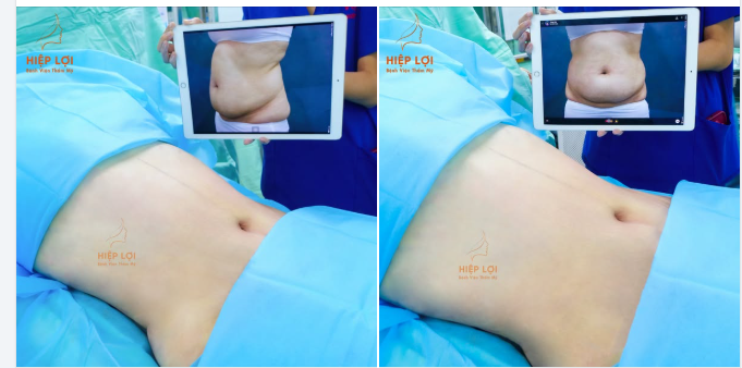 BIẾN HÌNH VÒNG EO – CHỈ SAU 1 LẦN HÚT MỠ