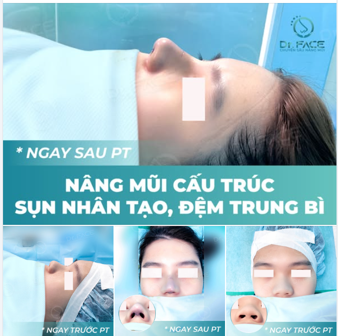 Mẹ yêu cầu em: “PHẢI NÂNG MŨI TẠI DR.FACE”