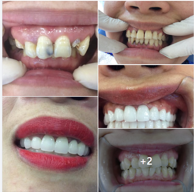 Cách Chăm Sóc Để Răng Sứ Tồn Tại Lâu Dài Hơn