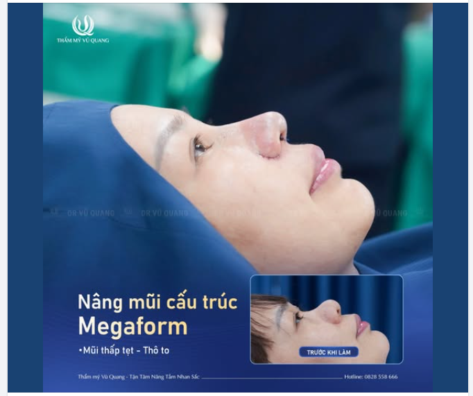 Kết quả nâng mũi MEGAFORM tại Dr. Vũ Quang – Lột xác ngoạn mục, đẹp ngỡ ngàng!