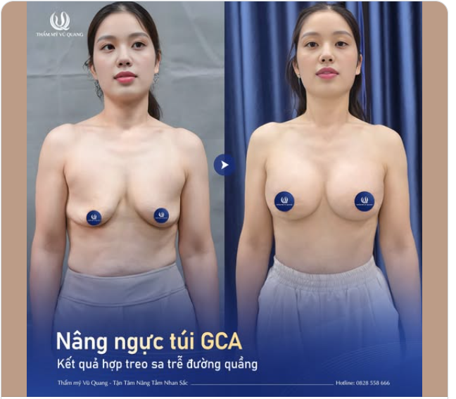 HÀNH TRÌNH THAY ĐỔI VÒNG 1 CỦA MẸ BỈM 2 CON