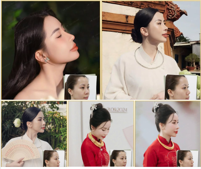 Mũi cũ đã qua 1 lần nâng cấp của quý Cô trước khi tìm đến Thế Giới Đẹp đã gặp phải loạt vấn đề: