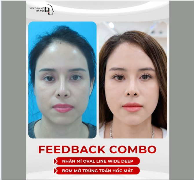 Combo nhấn mí Oval Line Wide Deep + Bơm mỡ trũng trần hốc mắt
