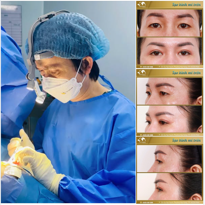 Ở tuổi ngoài 40, khi mí mắt bắt đầu xuất hiện da dư và tình trạng mí lót che phủ, đôi mắt dễ mất đi sự linh hoạt, làm tổng thể gương mặt kém tươi sáng.