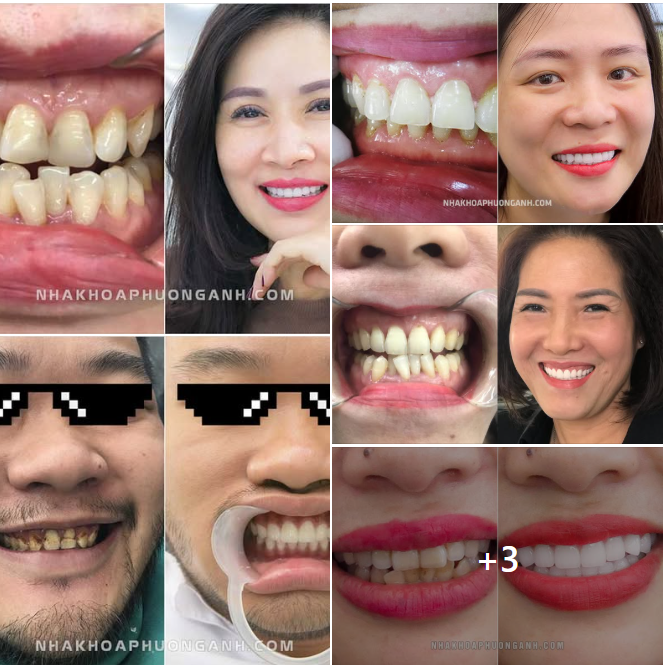 Hình ảnh trước và sau phục hình răng sứ thẩm mỹ