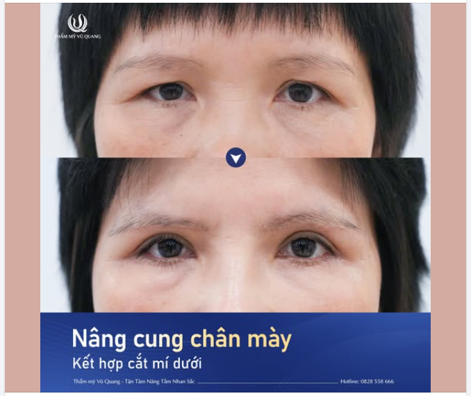FLEX COMBO NÂNG CUNG CHÂN MÀY VÀ CẮT MÍ - TRẺ LẠI 5 TUỔI NGAY TỨC THÌ