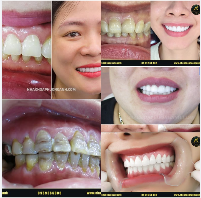 Tạm biệt hàm răng Tối màu u ám, xô lệch – chào đón nụ cười trắng sáng rạng rỡ!