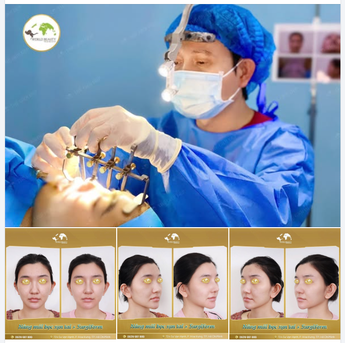 Cùng Thế Giới Đẹp theo dõi kết quả khi Cô nàng đến tái khám sau khi thực hiện nâng mũi cấu trúc bọc sụn tai