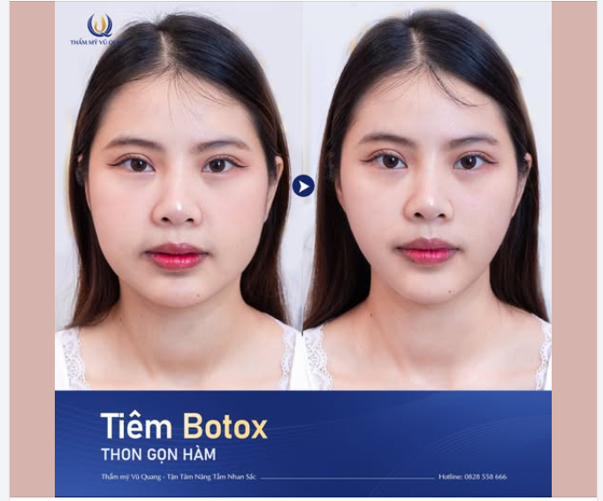 TẠM BIỆT GƯƠNG MẶT GÓC CẠNH - NGAY SAU KHI TIÊM GỌN GÓC HÀM