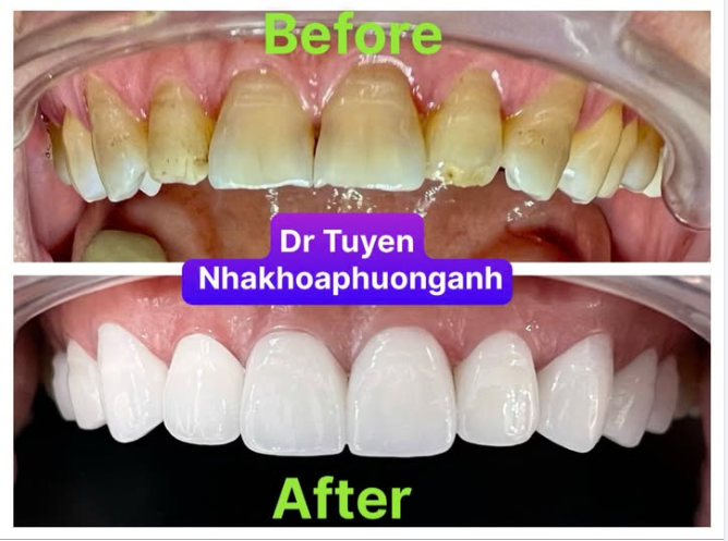Cách Chọn Màu Răng Sứ Tự Nhiên Nhất?