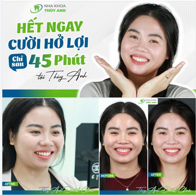 CHỈ 45 PHÚT ĐỔI LẤY NỤ CƯỜI ĐẸP CHUẨN TỈ LỆ CẢ NĂM