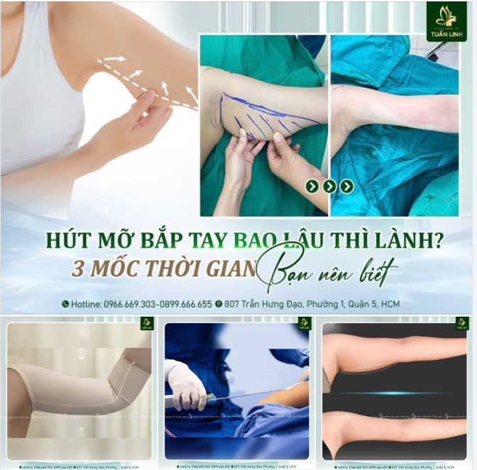Hút mỡ bắp tay bao lâu thì lành? – 3 mốc thời gian bạn cần nhớ!