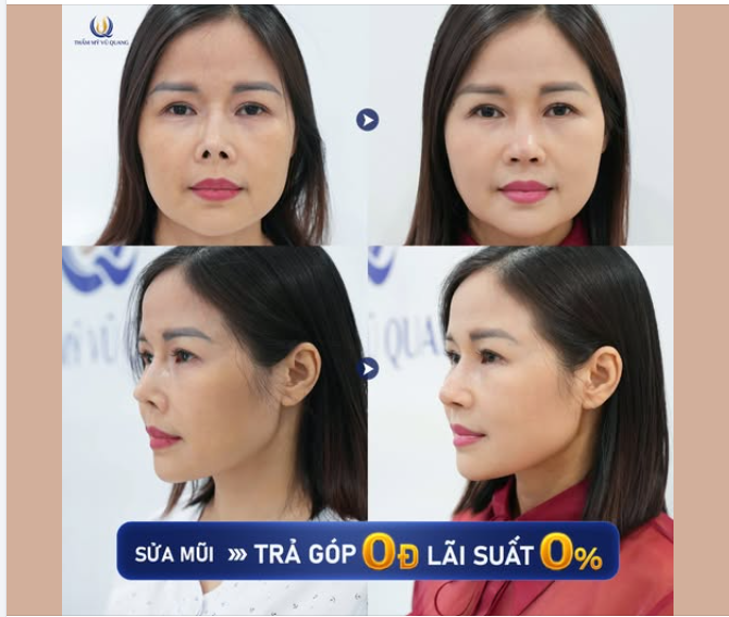 TẶNG 29 SUẤT NÂNG MŨI GIÁ GỐC – Đẹp không cần chờ đợi!