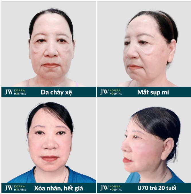 VIỆT KIỀU MỸ U70 VỠ ÒA HẠNH PHÚC VỚI DIỆN MẠO TRẺ 20 TUỔI SAU COMBO CẢI LÃO CHUYÊN SÂU TẠI JW