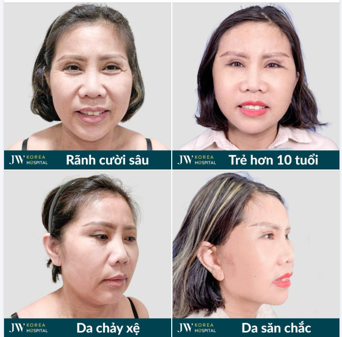 JW TẠO NÊN PHÉP MÀU CHO QUÝ CÔ U50 VIỆT KIỀU ĐỨC – KHUÔN MẶT TÁI SINH TRẺ 10 TUỔI SAU CĂNG DA MẶT SMAS PRO