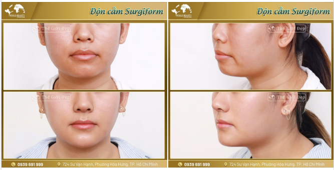 Cùng theo dõi kết quả sau khi Khách hàng 9x lựa chọn độn cằm Surgiform tại Thế Giới Đẹp
