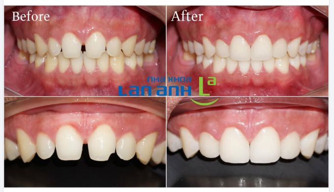 Veneer xâm lấn tối thiểu tại nha khoa Lan Anh: mài răng thì rất ít, nhưng kết quả thì rất ấn tượng
