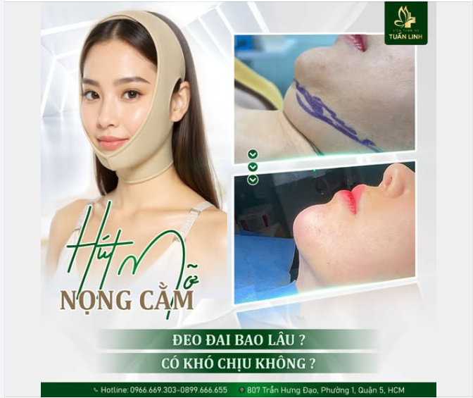 Hút mỡ nọng cằm – Đeo đai bao lâu, có khó chịu không?
