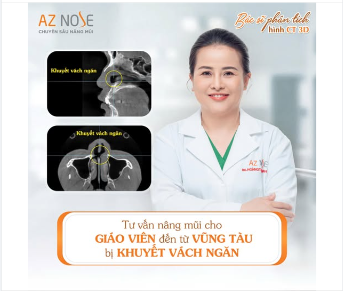 Tư vấn nâng mũi cho khách hàng đến từ Vũng Tàu bị khuyết cánh mũi