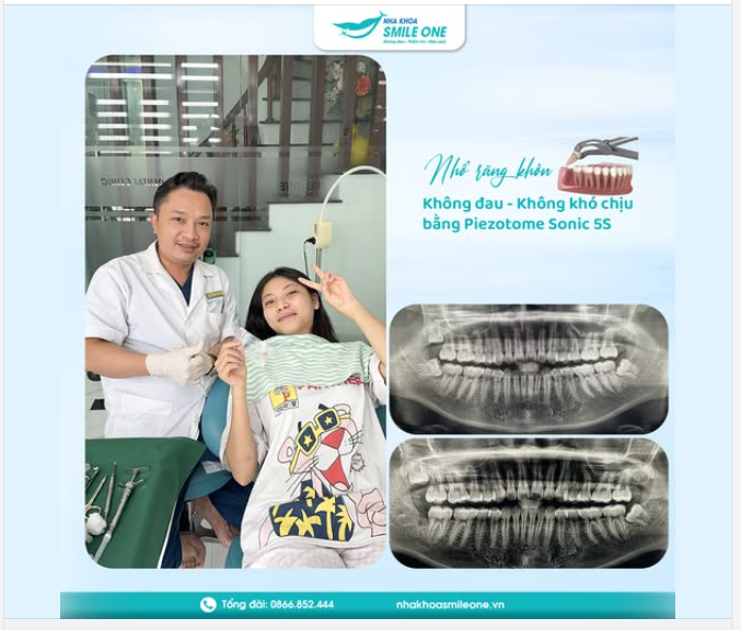 Một chiếc răng khôn mọc lệch được BS Tuấn Dương xử lý nhanh gọn và không gây đau đớn cho khách hàng.