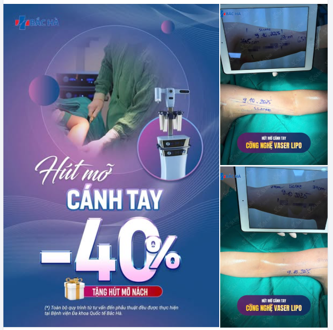 BẮP TAY THON GỌN – XOÁ TAN NGẤN MỠ.