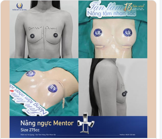 TỰ NHIÊN ĐẾN BẤT NGỜ! AI BẢO NÂNG NGỰC LÀ GIẢ?
