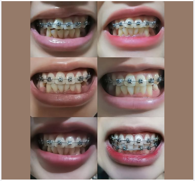 Bố mẹ hãy đầu tư chỉnh nha cho các bé càng sớm càng tốt, đây sẽ là hành trang giúp các em tự tin hơn trong học tập và vui chơi