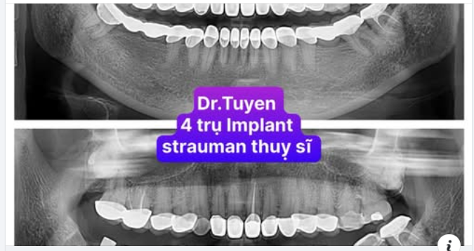 Tuổi Thọ Của Implant Răng: Những Điều Bạn Cần Biết