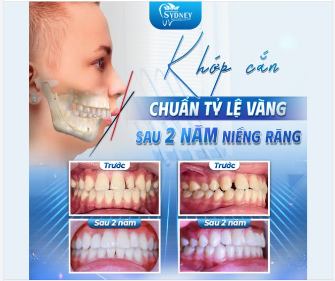 KHỚP CẮN ĐẠT CHUẨN TỶ LỆ VÀNG SAU 2 NĂM NIỀNG RĂNG