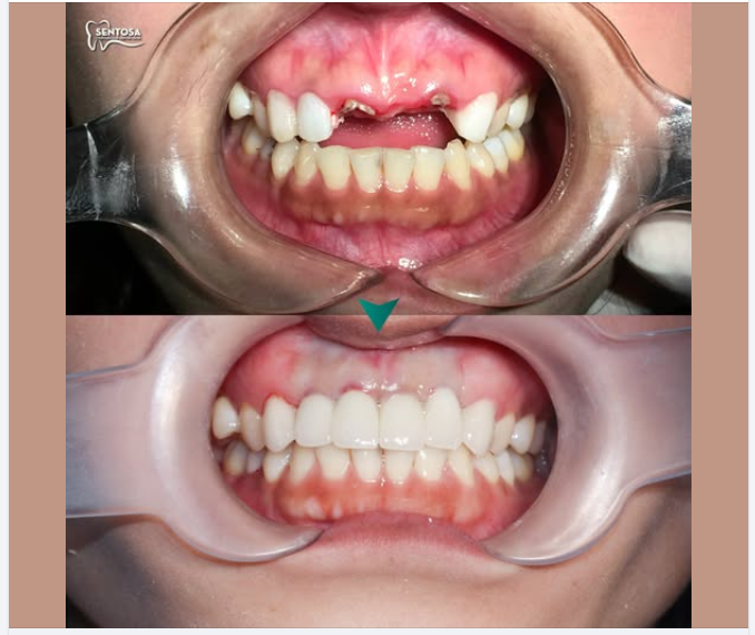 Khoảng trống 3 răng cửa biến mất – nụ cười rạng ngời quay về