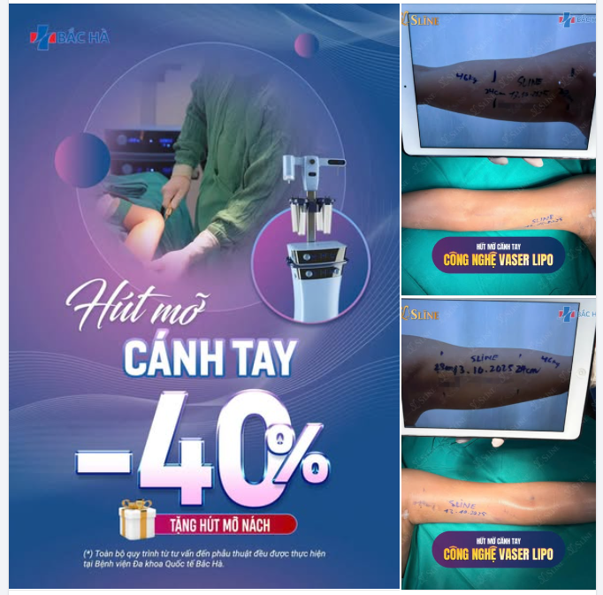 CÁNH TAY THON GỌN – TỰ TIN KHOE DÁNG