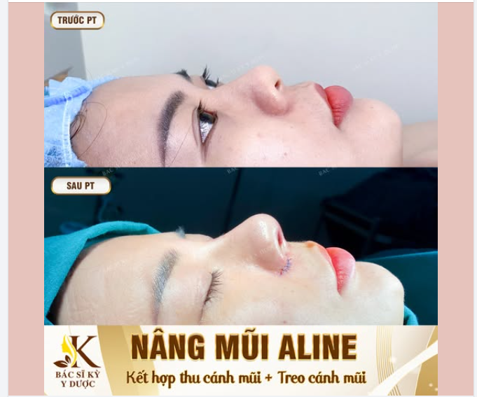 Sau Nâng Mũi ALINE – khác biệt từ từng góc nhìn