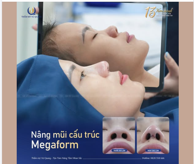 Nâng mũi cấu trúc Megaform – Bí quyết để gương mặt thanh thoát, thần thái cuốn hút hơn bao giờ hết
