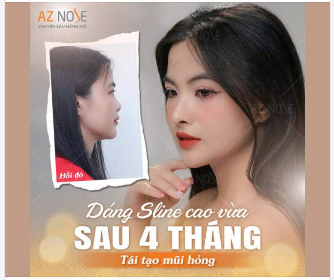 Tìm lại tự tin sau 4 tháng tái tạo mũi hỏng cùng Bác sĩ CKI. Nguyễn Hoàng Nam