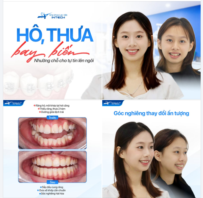 PHÉP MÀU TỪ NIỀNG RĂNG: KHÁNH HUYỀN VÀ HÀNH TRÌNH ĐỔI THAY GÓC NGHIÊNG ẤN TƯỢNG