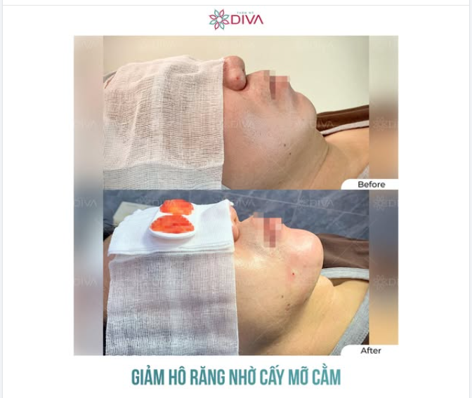 CẤY MỠ VÙNG CẰM GIÚP LÀM GIẢM HÔ MIỆNG?