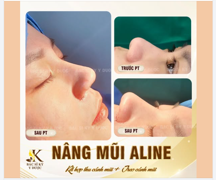 Kết quả nâng mũi ALINE tại Bác sĩ Kỳ Y Dược