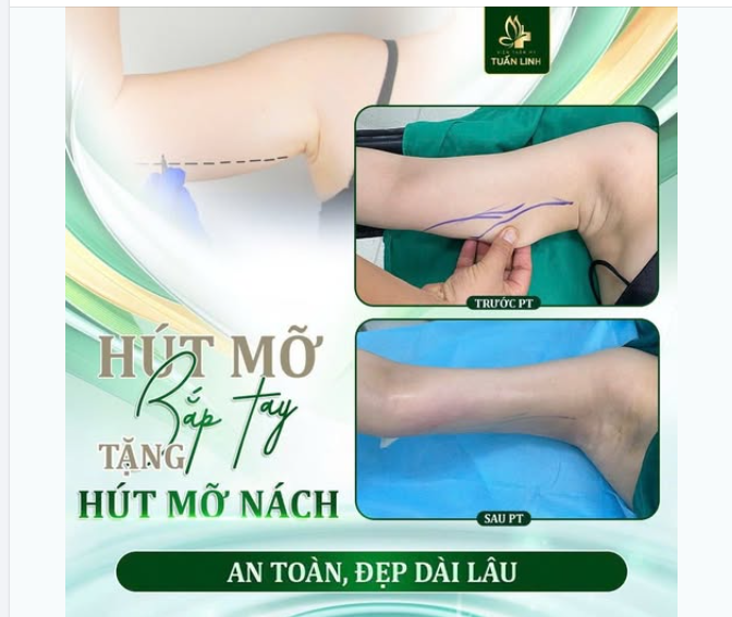 HÚT MỠ BẮP TAY TẶNG NGAY HÚT MỠ NÁCH!!