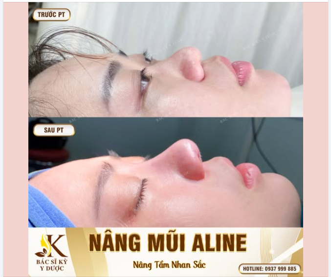 Kết quả nâng mũi tại Cần Thơ – Bác sĩ Kỳ Y Dược   Phẫu thuật được thực hiện tại bệnh viện